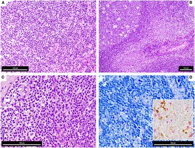 Case Report: Gene expression profiling of COVID-19 vaccination-related lymphadenopathies reveals evidence of a dominantly extrafollicular immune response